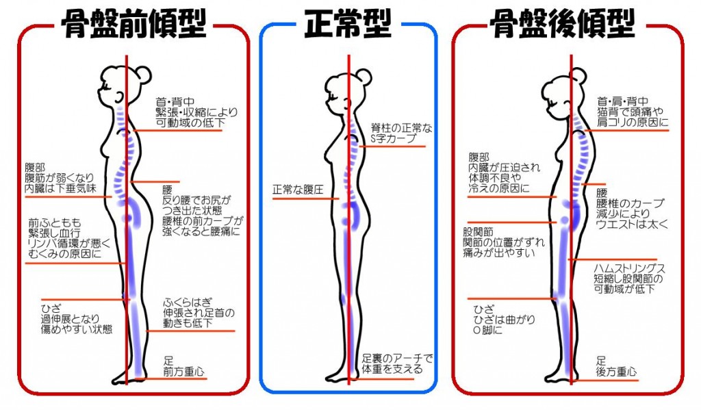 反り腰　猫背　姿勢　腰痛