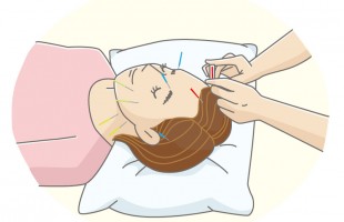 美容鍼　女性　エステ
