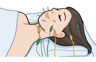 美容鍼　イラスト　電気